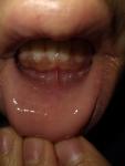 Жжение, боль припухлостей в слизистой нижней губы фото 5