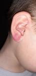 Красное пятно на мочке уха фото 1