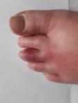 Болит, покраснел и опух средний палец ноги фото 1