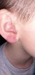 Красное пятно на мочке уха фото 3