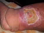 На левой ноге на голени незаживающая постоянно сочащаяся рана фото 2