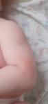 Пятнышки на теле младенца фото 3