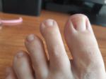 Пятно на ногте большого пальца левой ноги фото 2