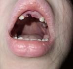 Кровяной сгусток шариком, на месте выпавшего зуба у ребенка фото 1