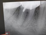 Удаление зуба с коронкой фото 1