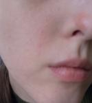 Сильное шелушение кожи и аллергия на крема фото 2
