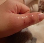 Опух палец после укуса кота фото 2