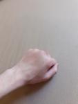Опухшая область костяшки левой руки фото 1