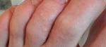 Мелкие водянистые прищики на пальцах ног, зуд фото 1