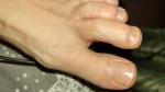 Мелкие водянистые прищики на пальцах ног, зуд фото 3