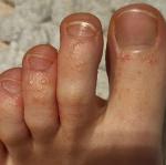Мелкие водянистые прищики на пальцах ног, зуд фото 2