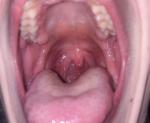 Опух язычок в горле, вокруг красные пятна фото 1