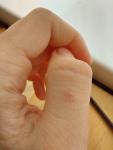 Болит красная точка на пальце при прикосновении фото 3
