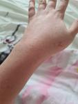 Сыпь на внутренней стороне рук и на локтевых сгибах фото 1