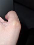 Уплотнение на сгибе пальца фото 4