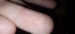 Красные воспаления (точки) под кожей подушечек пальцев рук фото 1