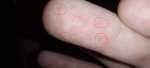 Красные воспаления (точки) под кожей подушечек пальцев рук фото 2