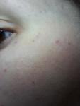 Петехии на лице или аллергическая реакция? фото 1