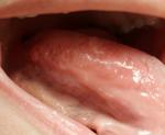 Воспаление на языке с двух сторон фото 1