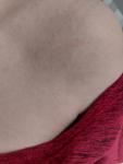 Сыпь по всему телу похожая на потницу или аллергию фото 1