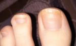 Изменение ногтя, это грибок или нет? фото 4