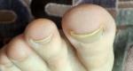 Изменение ногтя, это грибок или нет? фото 3