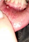 Пузырь на слизистой губы фото 1