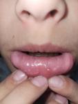 Нарушение слизимтой губы фото 2