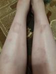 Пятна на ногах склеродермия фото 1