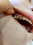 Образование на десне молочного зуба фото 1