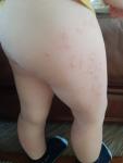 Красные пятна на ножках у ребенка фото 1