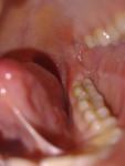 Воспаление десны, подозрение на зуб мудрости фото 1
