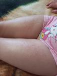 Мелкие прищики на теле у ребенка фото 2