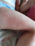 Сыпь на теле аллергия у ребёнка фото 1