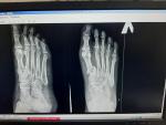 Перелом пальцев на ноге фото 1