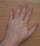 Болят суставы пальцев рук фото 1