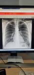 Рентген лёгких фото 1