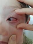 Ппокраснение в глазу у ребенка без других симптомов фото 4