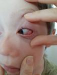Ппокраснение в глазу у ребенка без других симптомов фото 1