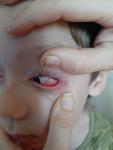 Ппокраснение в глазу у ребенка без других симптомов фото 2