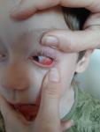Ппокраснение в глазу у ребенка без других симптомов фото 3