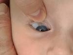 Изменение контура радужной оболочки глаза у ребенка фото 1