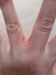 Воспаление между пальцами руки, что это может быть? фото 3