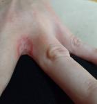 Воспаление между пальцами руки, что это может быть? фото 2