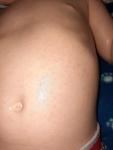Сыпь и зуд по телу у мальчика 2 года фото 4