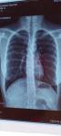 Рентген легких, бронхит, боли в грудной клетке фото 3