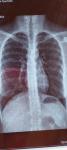 Рентген легких, бронхит, боли в грудной клетке фото 1