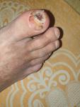 Незаживающая рана на большом пальце правой ноги фото 1