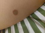 Плоское, круглое, коричневое пятно на ноге у ребенка фото 1
