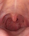 Нереальная боль при глотании, гранулы в горле фото 1